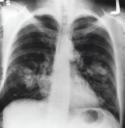 Detección de neumonía en radiografías de tórax con Deep Learning