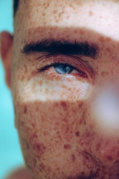 How Microneedling in London Helps with Acne Scars and Aging