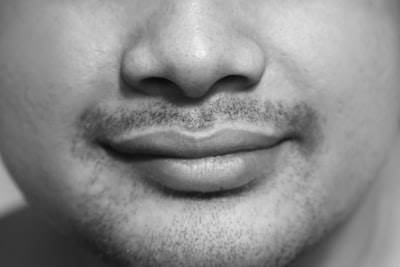 Tratamiento del melasma en el labio superior